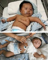 Extirpan con éxito el tercer brazo de un bebé chino de dos meses de edad/